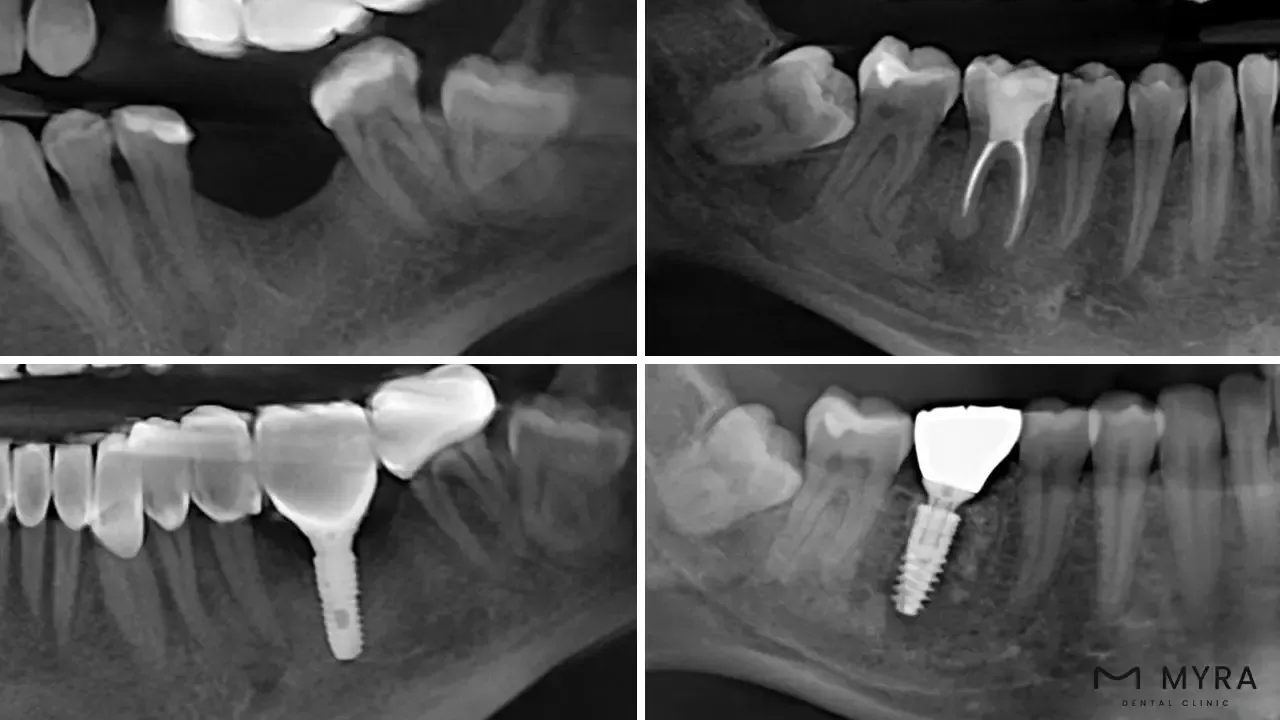 Immediate Load Dental Implant- Definition, Benefits, and Cost.webp